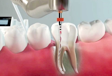 Endodonzia